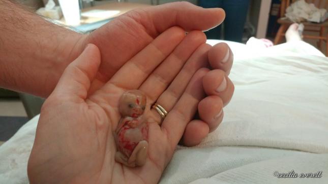 12 weeks miscarried baby abortions nz